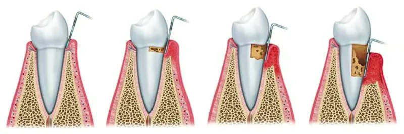 zahnstein und parodontose