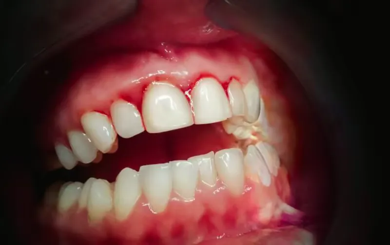 Gingivitis Zahnfleischentzündung
