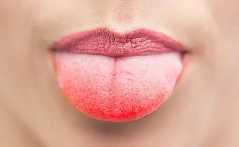 Zungenbelag als Ursache für Mundgeruch