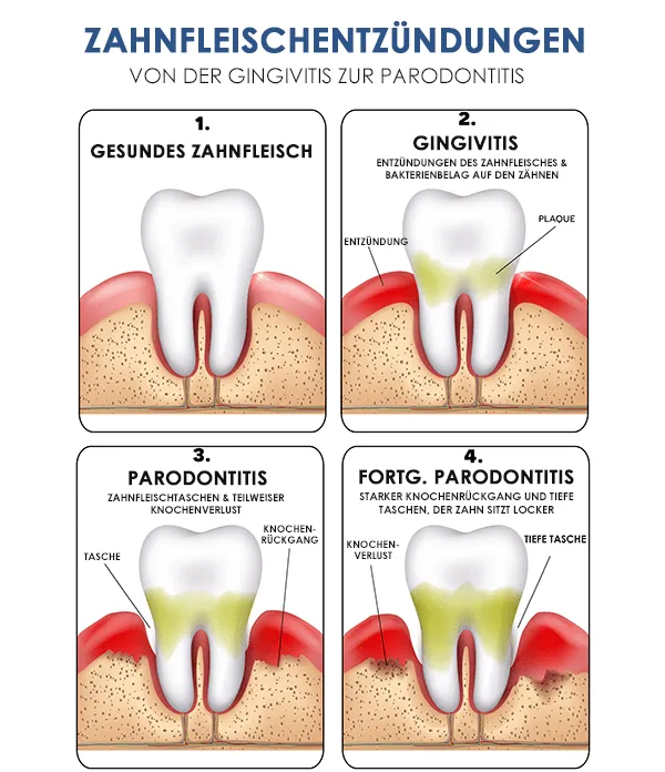 parodontose