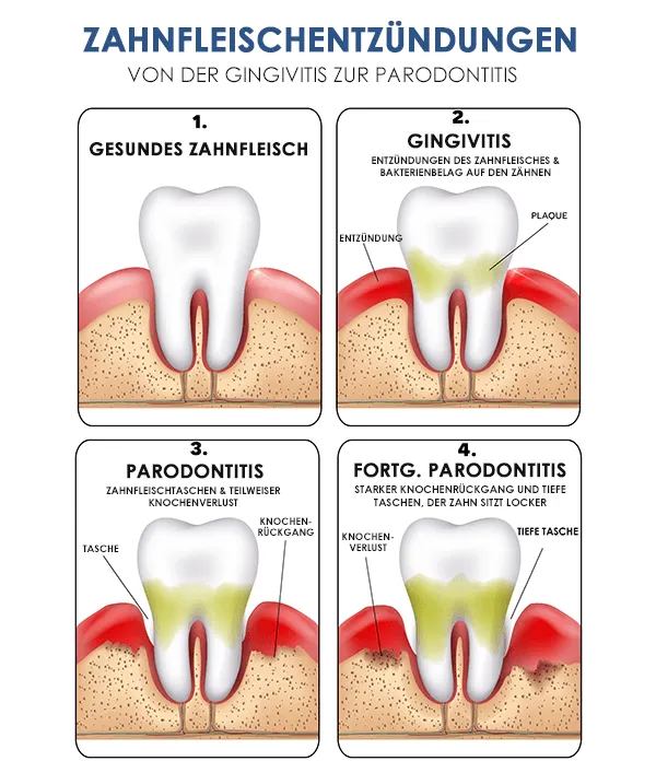 Verlauf einer Zahnfleischentzündung