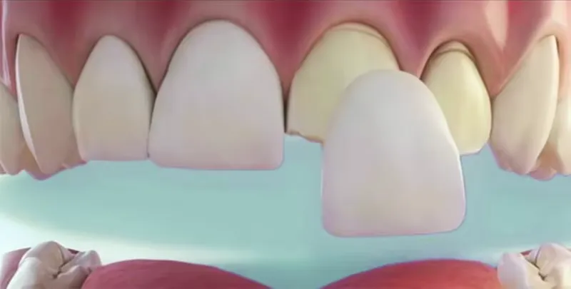 Veneers als Verblendung für Zähne
