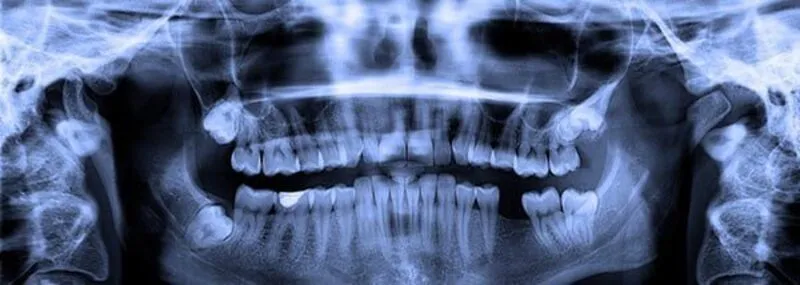 Röntgenaufnahme der Zähne