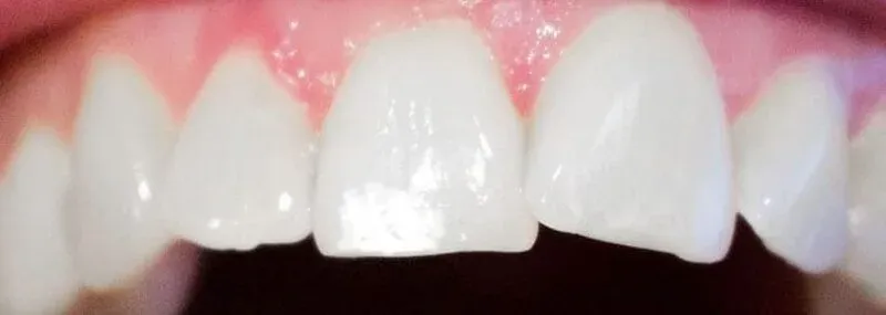 white spots auf den zähnen