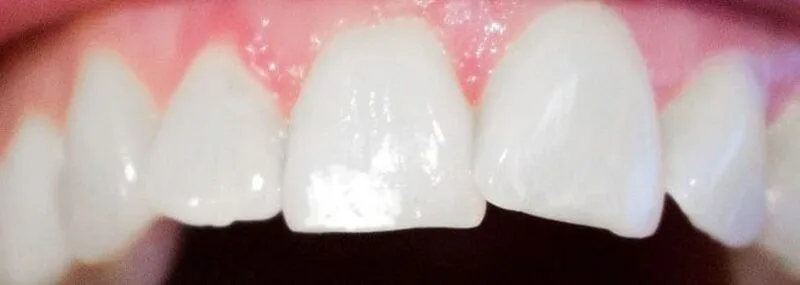 Weiße Flecken auf den Zähnen schädlich?