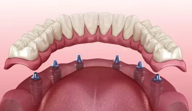 Bild einer kompletten künstlichen Zahnreihe